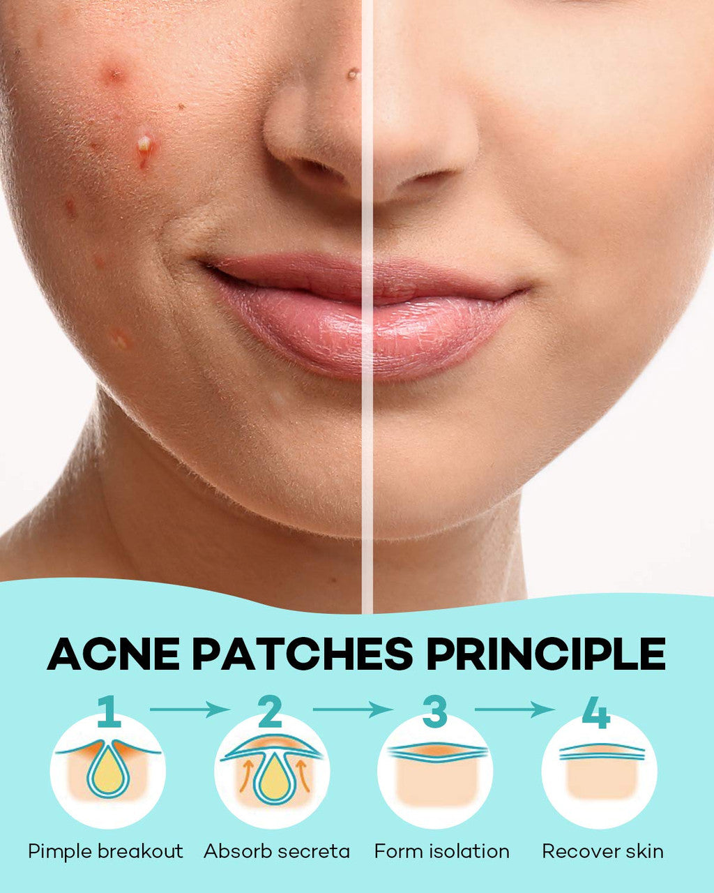 Acne Intensive Patch